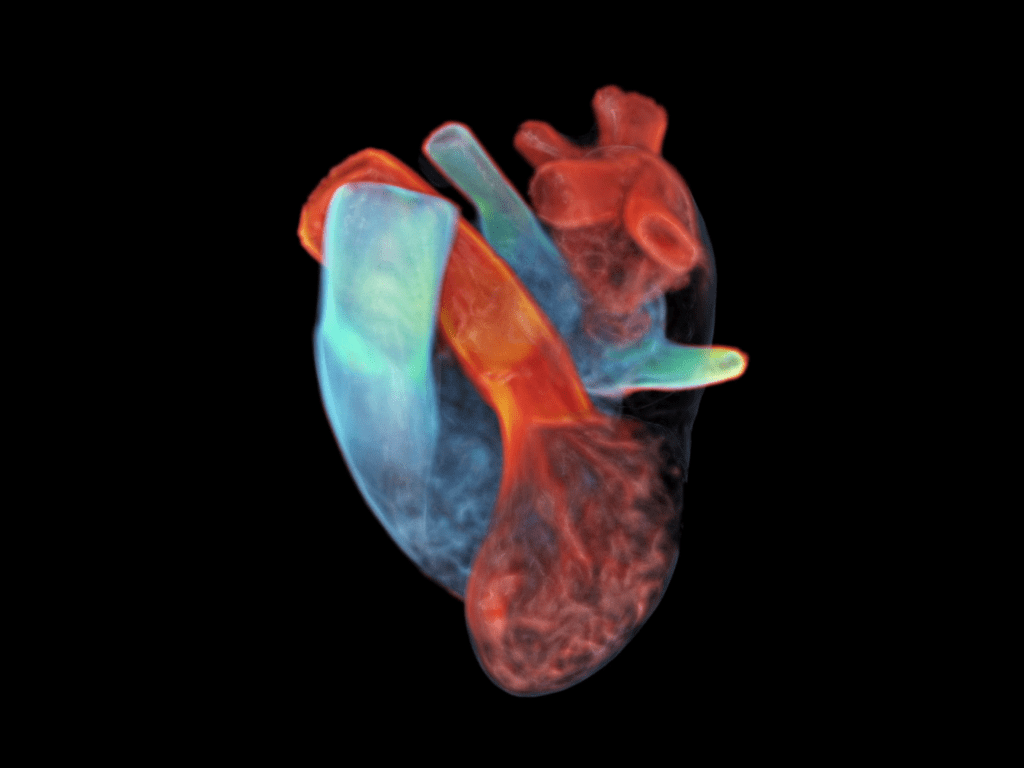 Siemens Healthineers nutzt Datensätze aus MRT- und EKG-Messungen zur Erstellung eines digitalen Zwillingsherzens